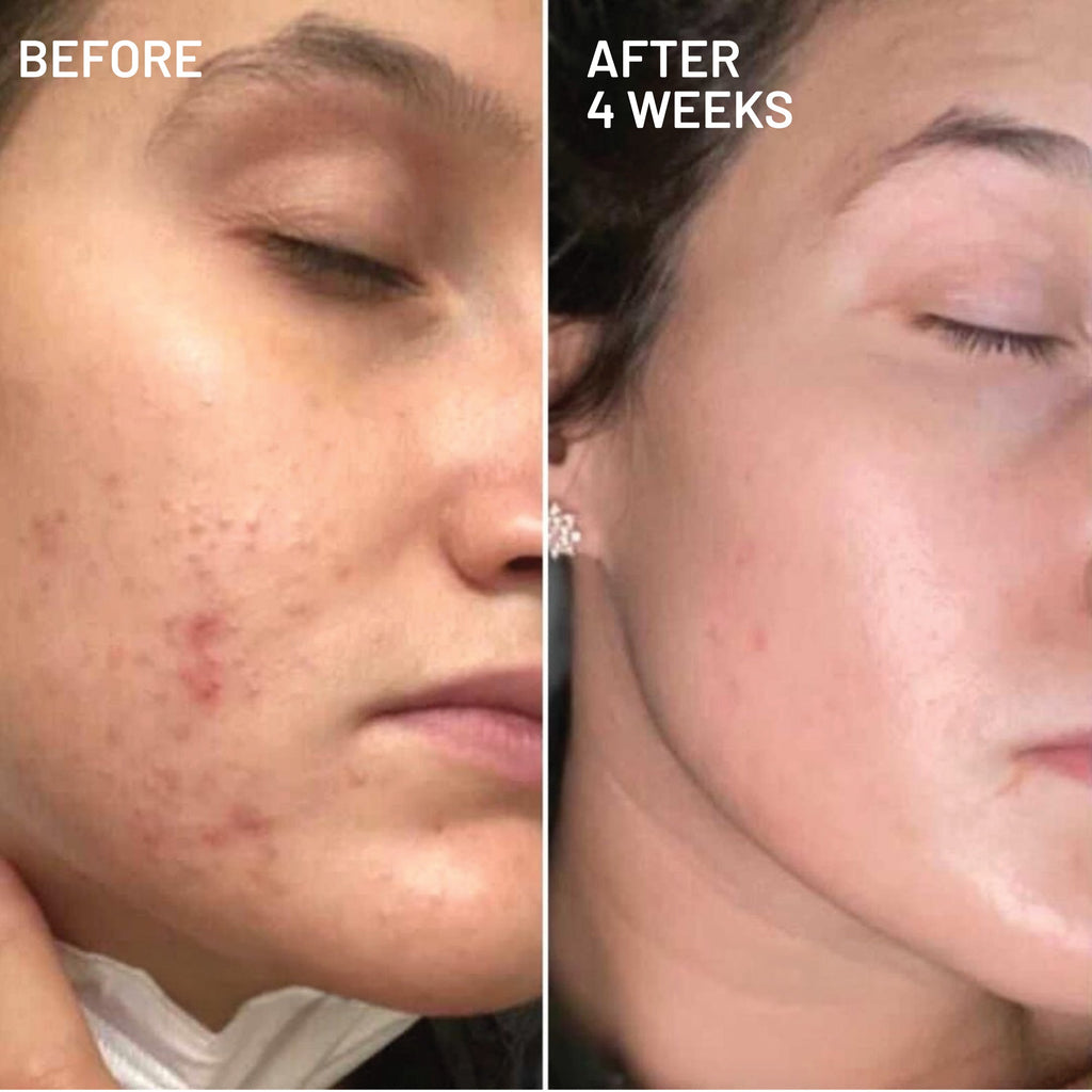 Hyperpigmentation & Melasma Routine