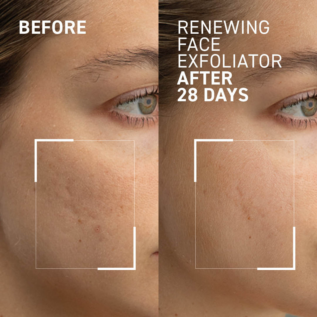 Gentle Microdermabrasion Face Exfoliator