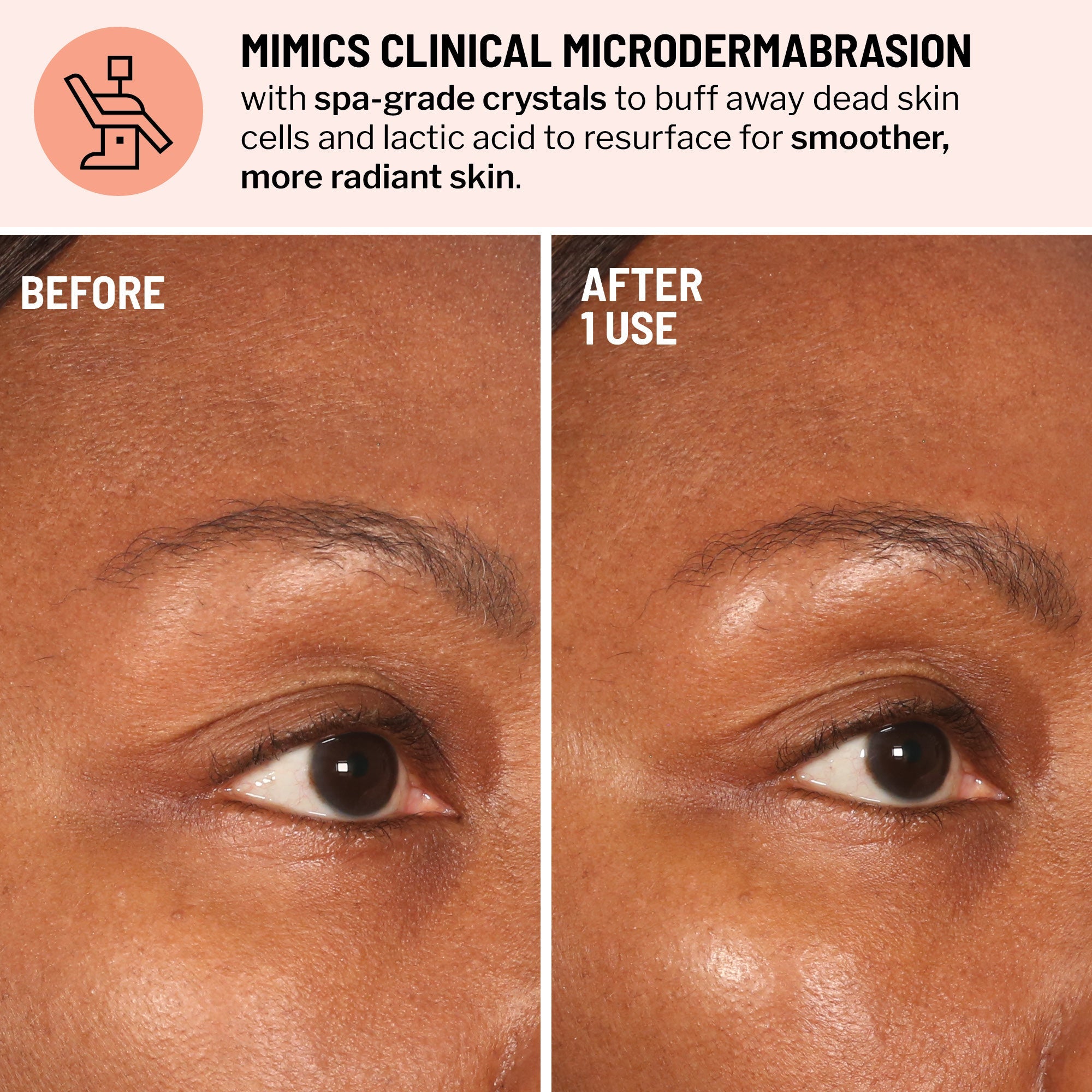 Advanced Microdermabrasion Face Exfoliator
