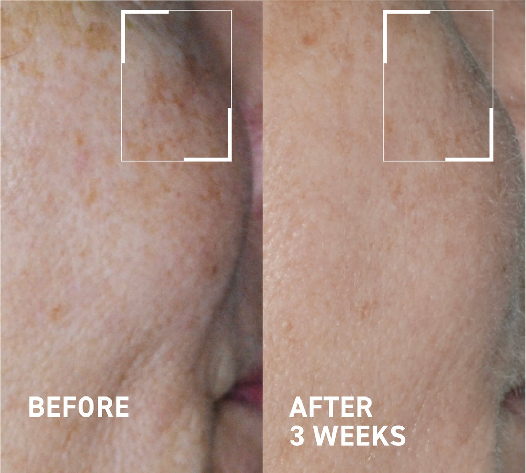 Hyperpigmentation & Melasma Routine