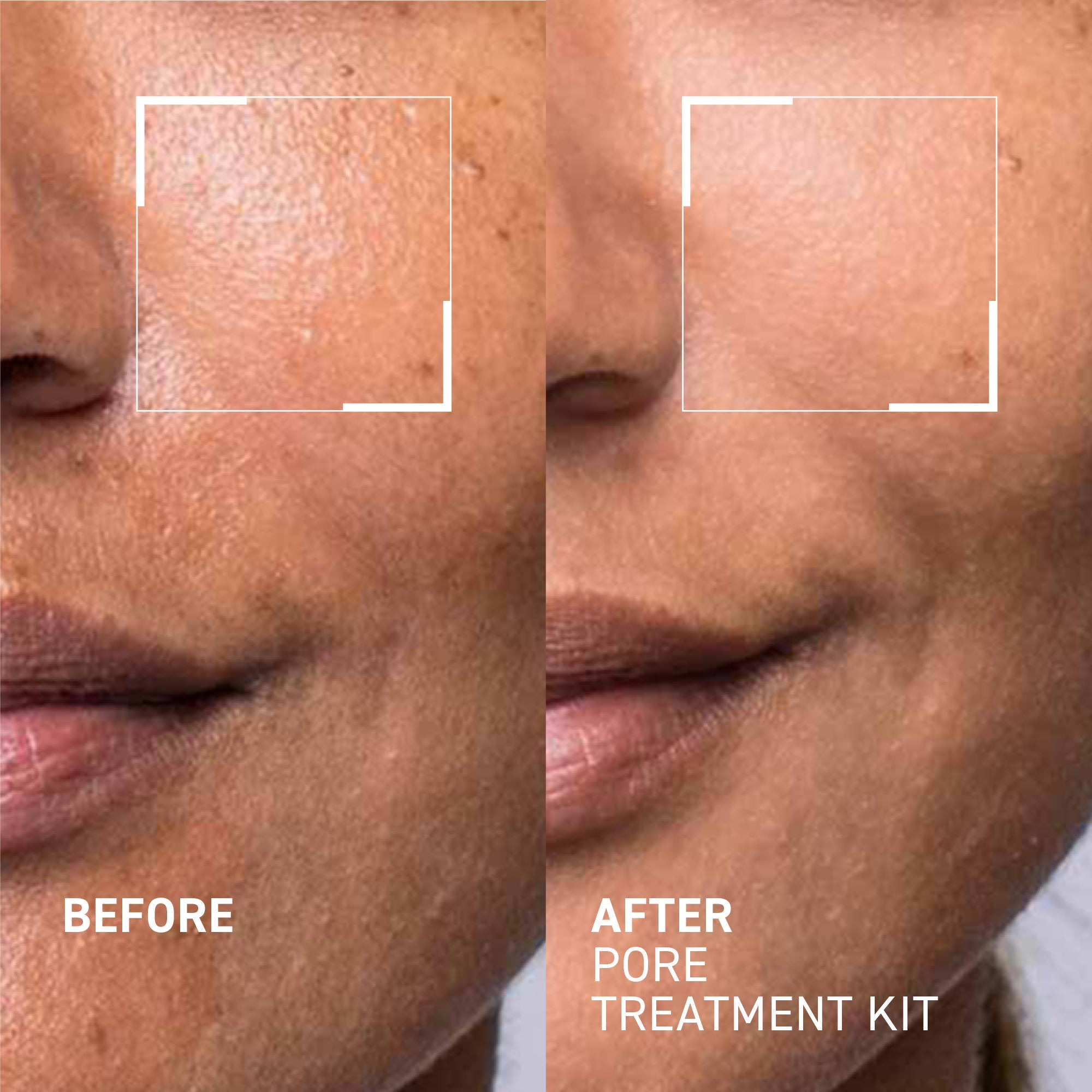 Pore Refining Treatment Kit